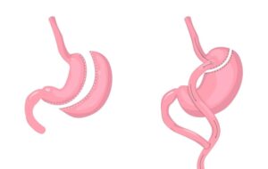 Anatomia do estômago e intestino após a gastrectomia vertical (à esquerda) e bypass gástrico (à direita.)